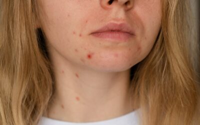 Les astuces pour lutter contre l’acné adulte