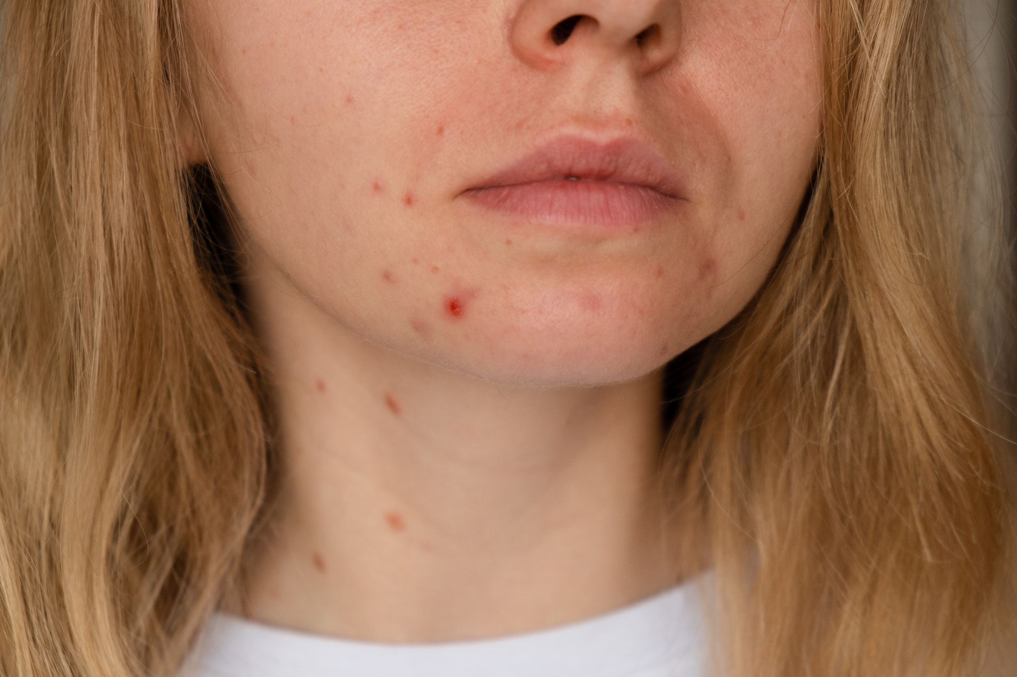 Comment lutter contre l'acné d'adulte ?