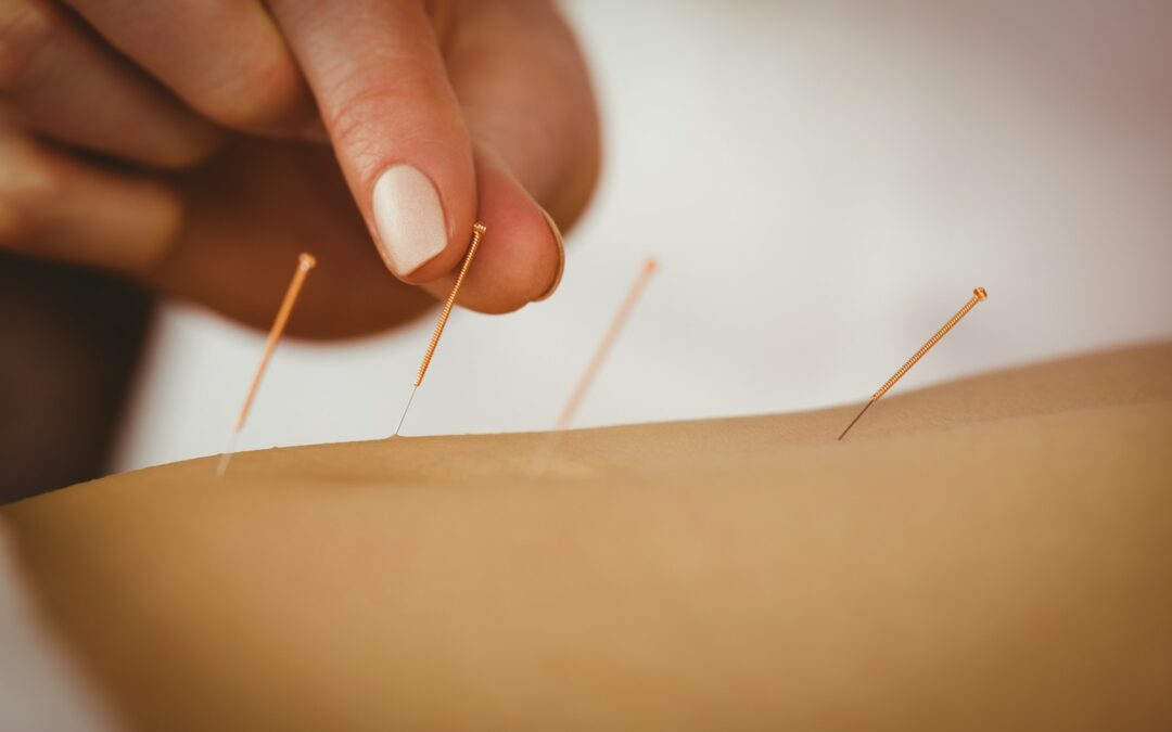 Acupuncture : Soulager les douleurs et retrouver l’équilibre