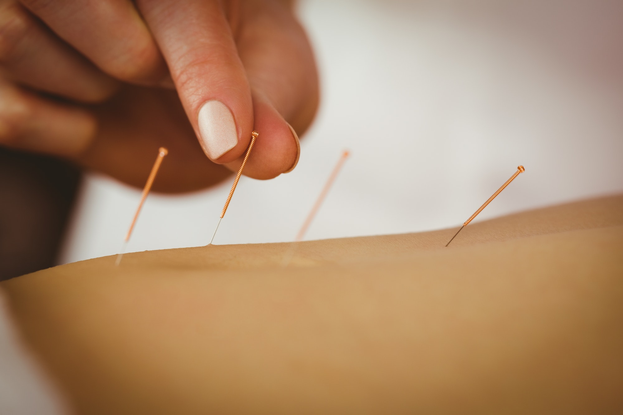 Soulagez vos douleurs grâce à l'acupuncture