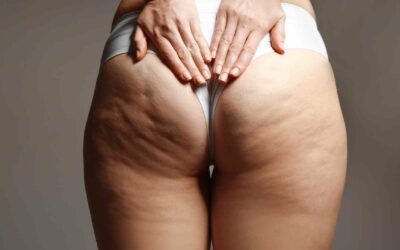 Les différentes techniques de kinésithérapie pour traiter la cellulite fibreuse