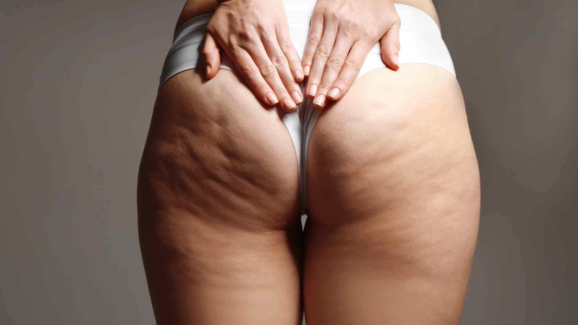 cellulite fibreuse