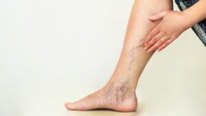 varices