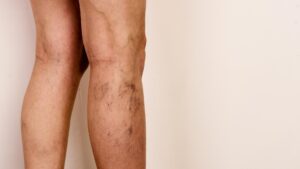 varices