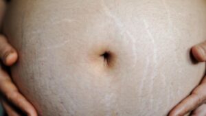 vergetures grossesse